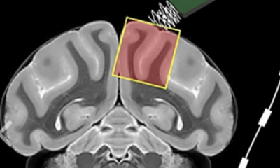 Art&iacute;culo de Opini&oacute;n: Los Ultrasonidos, &iquest;Medicina de Futuro? por Jordi A. Jauset